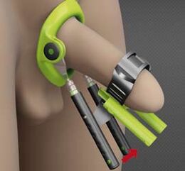 Recovery after surgery improves penis